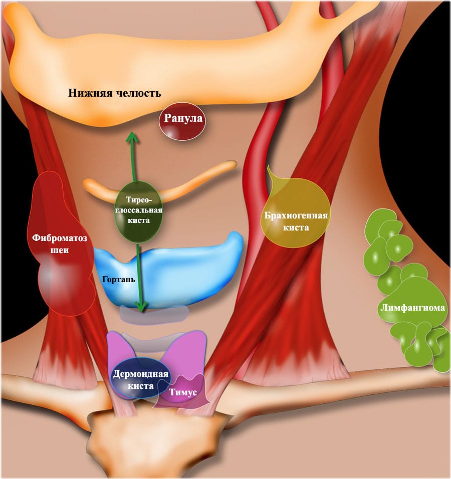 Срединная киста шеи - HNS-ORL